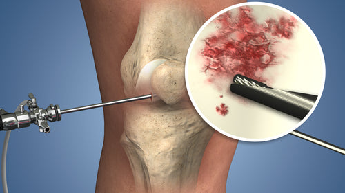 Medial Patellofemoral Ligament Reconstruction animation