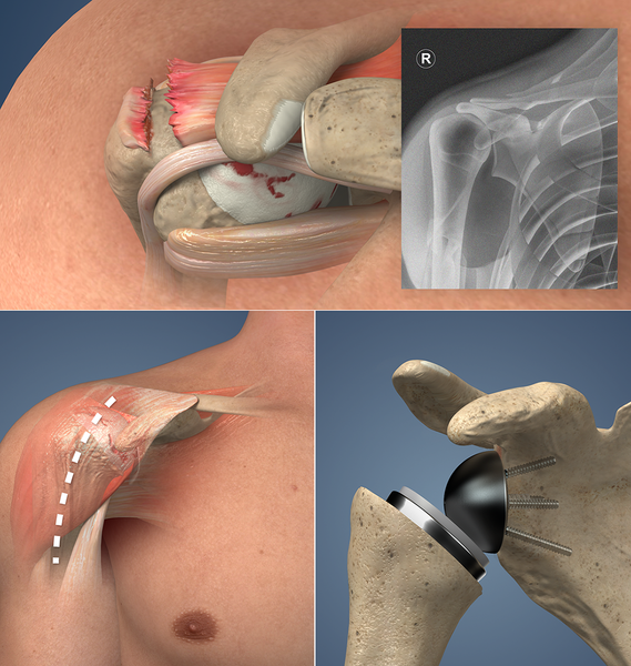 Understand.com® Expands Orthopaedic Library with the Release of Reverse Total Shoulder Replacement