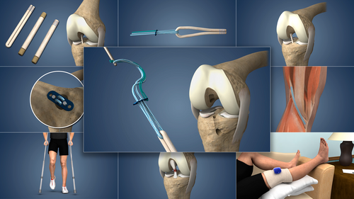 Understand.com<sup>®</sup> continues Orthopaedic Library enhancement with the release of our updated Torn ACL Reconstruction - Hamstring Graft animation