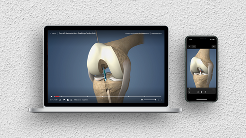 Understand.com<sup>®</sup> releases the latest HD update to our Orthopaedic Library: The Torn ACL Reconstruction - Quadriceps Tendon Graft animation