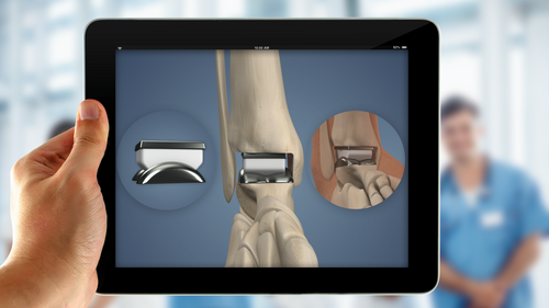 Understand.com® expands Orthopaedic Library with the release of the brand-new Total Ankle Replacement animation