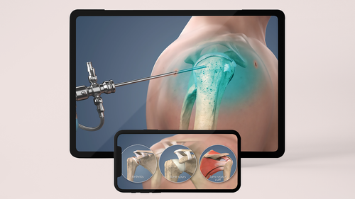 Understand.com® is excited to announce the latest update to our Orthopaedic Library with the HD release of our Diagnostic Shoulder Arthroscopy animation