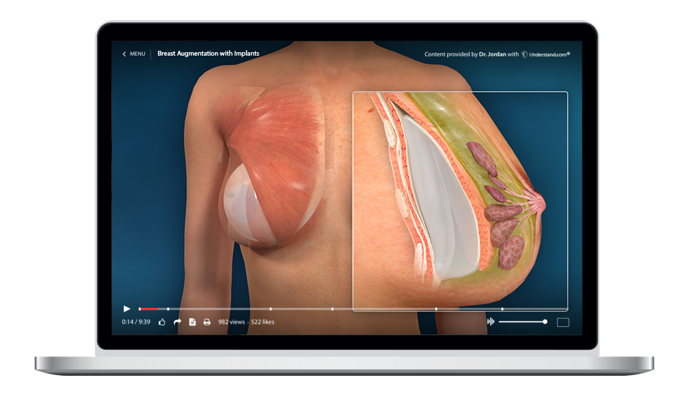 laptop showing a customized Breast Augmentation with Implants