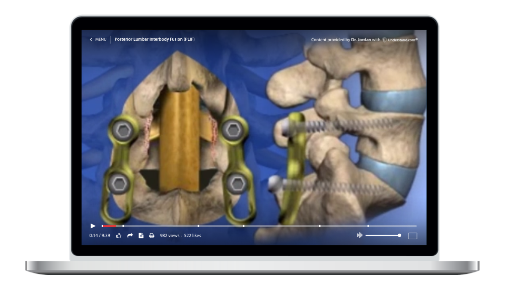 laptop showing a customized Lumbar - Posterior Lumbar Interbody Fusion (PLIF) Animation