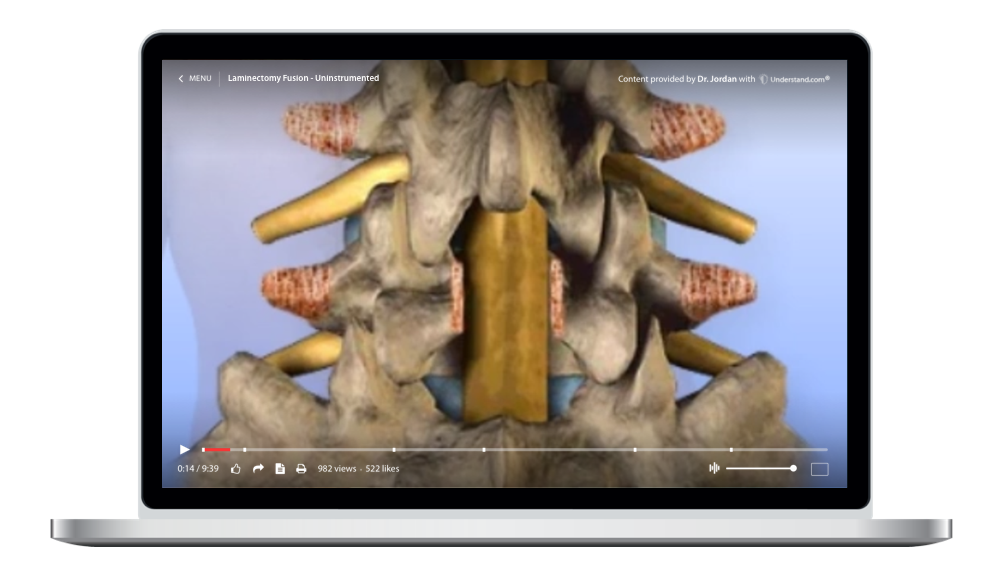 laptop showing a customized Lumbar - Laminectomy, Fusion - Uninstrumented Animation