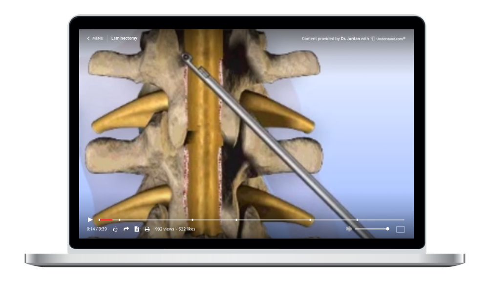 laptop showing a customized Lumbar - Laminectomy Animation