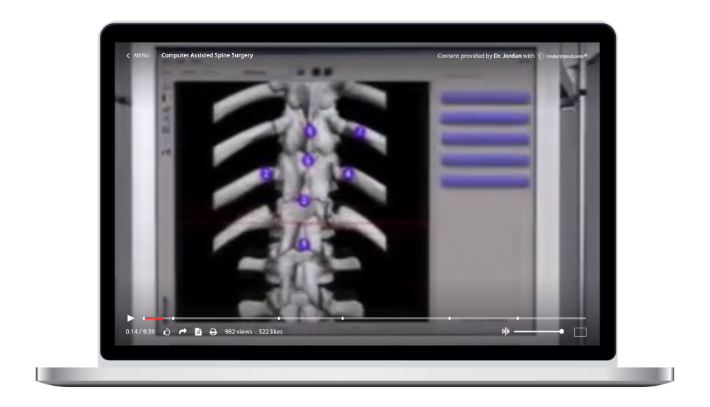 laptop showing a customized Computer-Assisted Spine Surgery Animation