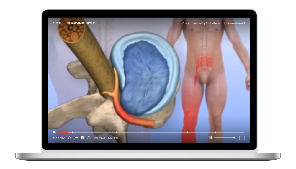 laptop showing a customized Herniated Disc - Lumbar Animation