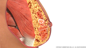 breast-cancer-fibroadenoma