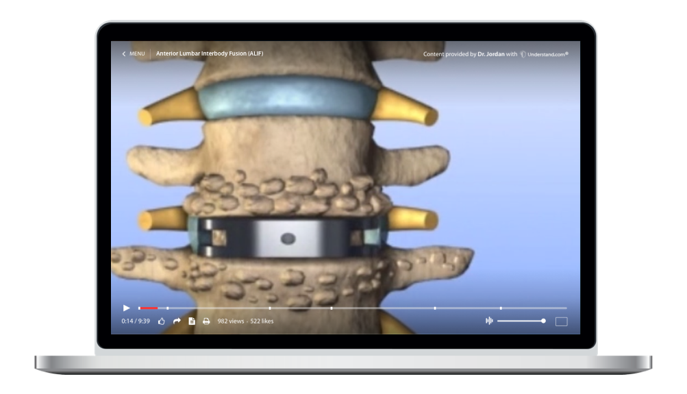 laptop showing a customized Lumbar - Anterior Lumbar Interbody Fusion (ALIF) Animation