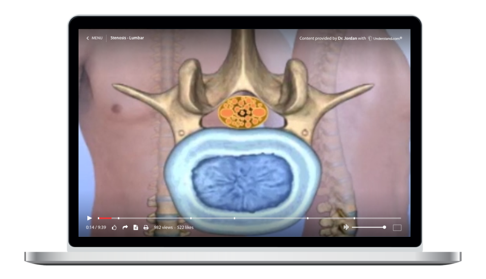 laptop showing a customized Stenosis - Lumbar Animation