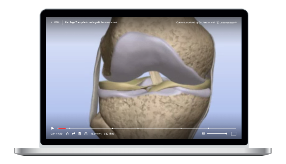 laptop showing a customized Cartilage Transplants - Allograft (from cadaver) Animation