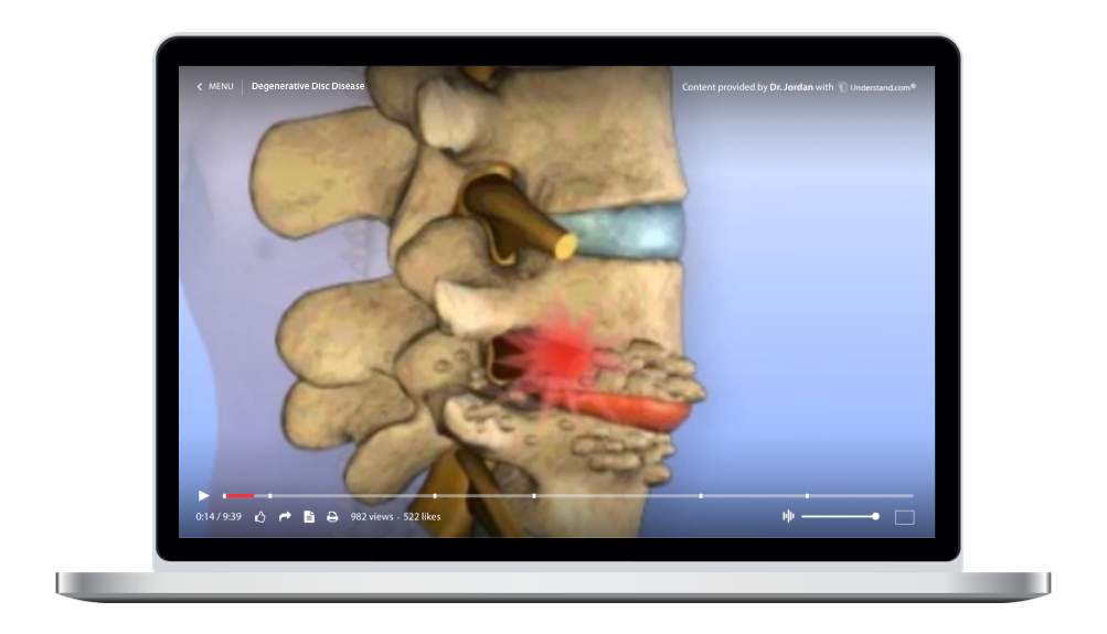 laptop showing a customized Degenerative Disc Disease Animation