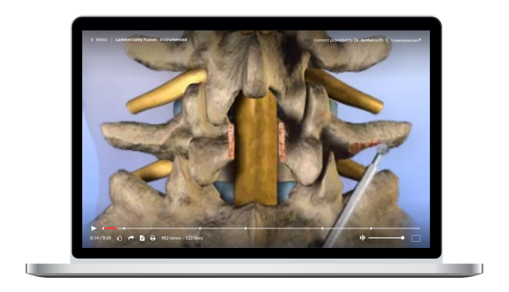 laptop showing a customized Lumbar - Laminectomy, Fusion - Instrumented Animation