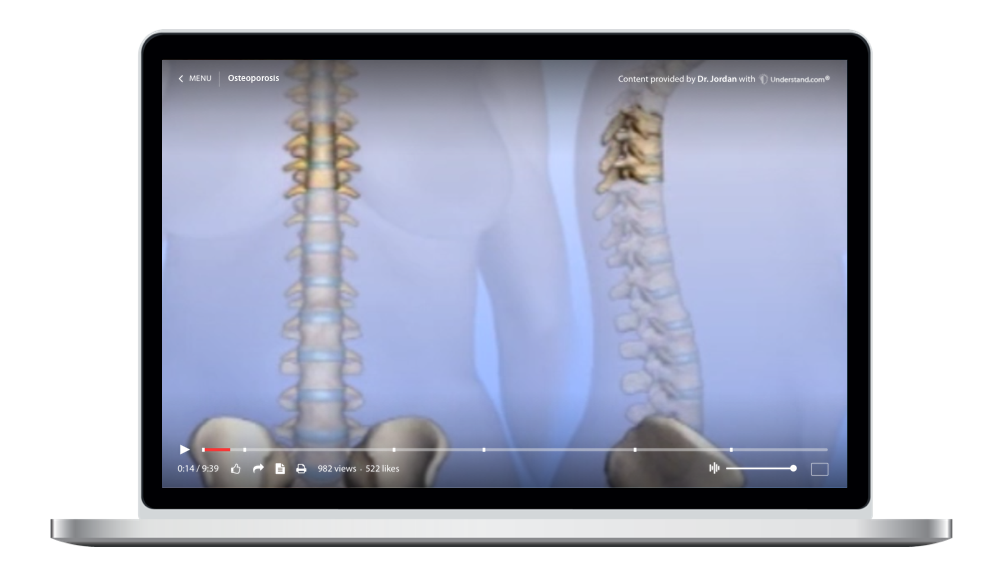 laptop showing a customized Osteoporosis Animation