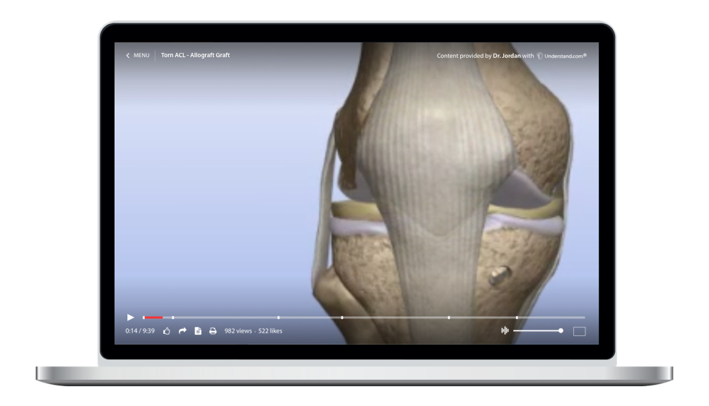 laptop showing a customized Torn ACL - Allograft Animation