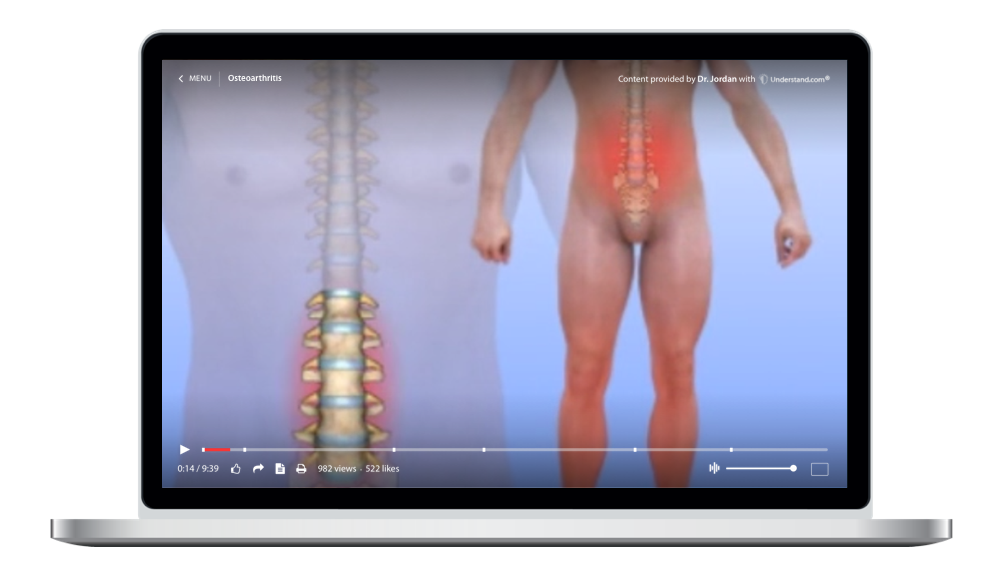 laptop showing a customized Osteoarthritis Animation