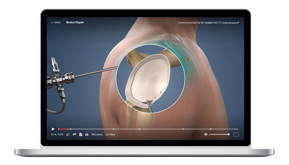 Bankart Repair Animation