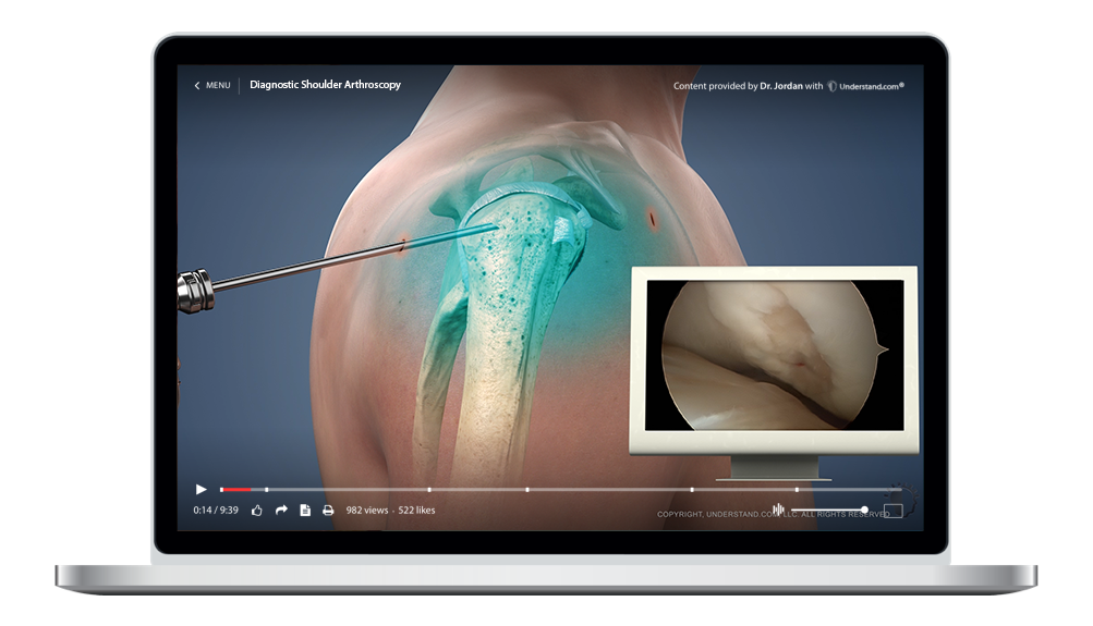 laptop showing a customized Diagnostic Shoulder Arthroscopy Animation