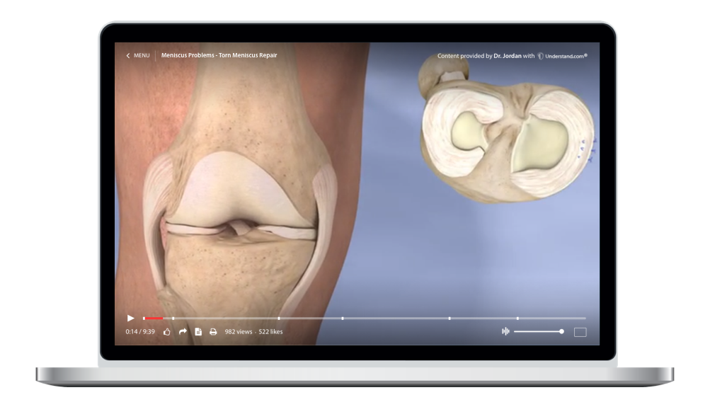 laptop showing a customized Meniscus Problems - Torn Meniscus Repair Animation