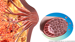 breast-cancer-invasive-carcinoma