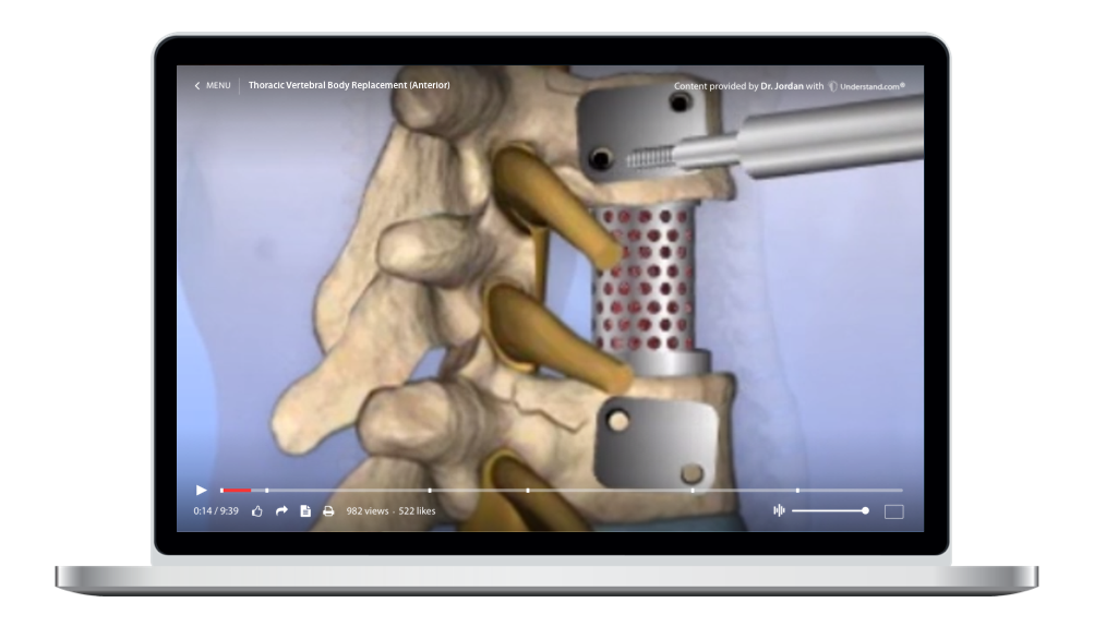 laptop showing a customized Thoracic - Thoracic Vertebral Body Replacement (Anterior) Animation