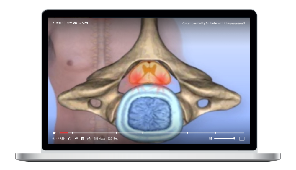 laptop showing a customized Stenosis - Cervical Animation