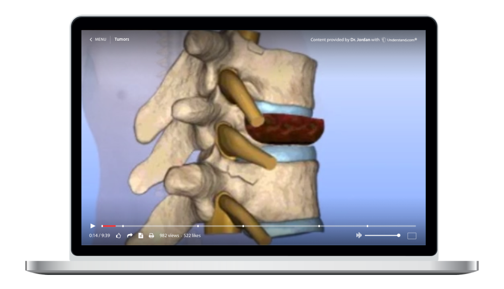 laptop showing a customized Tumors Animation