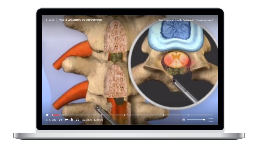 laptop showing a customized Thoracic - Thoracic Laminectomy and Instrumentation Animation