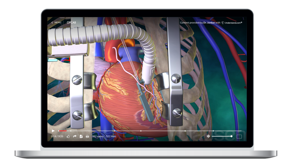 laptop showing a customized OPCAB Animation