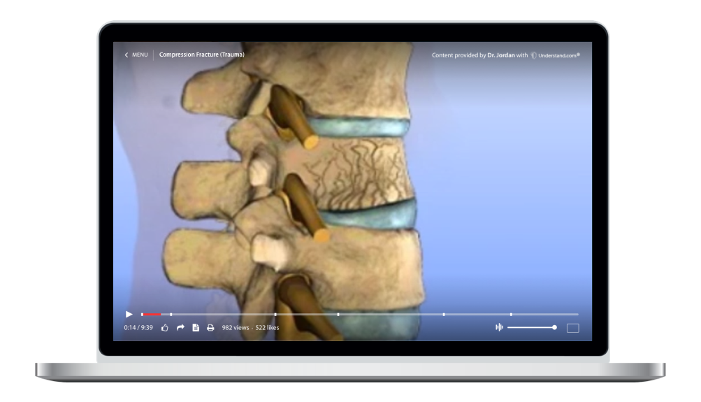 laptop showing a customized Compression Fracture (Trauma) Animation
