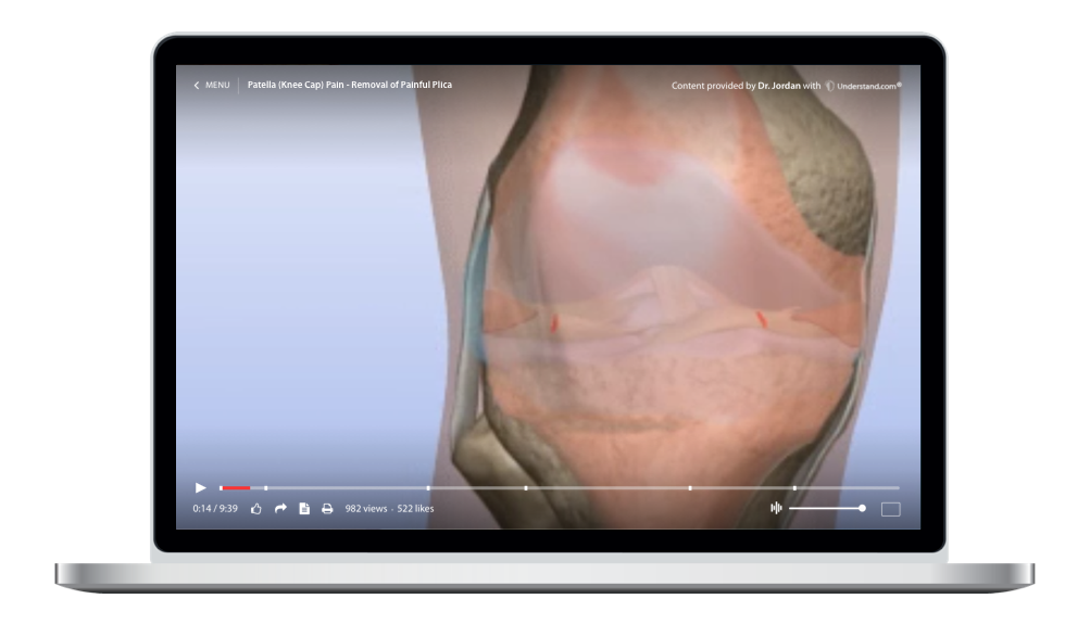 Patella (Knee Cap) Pain Removal of Painful Plica Animation