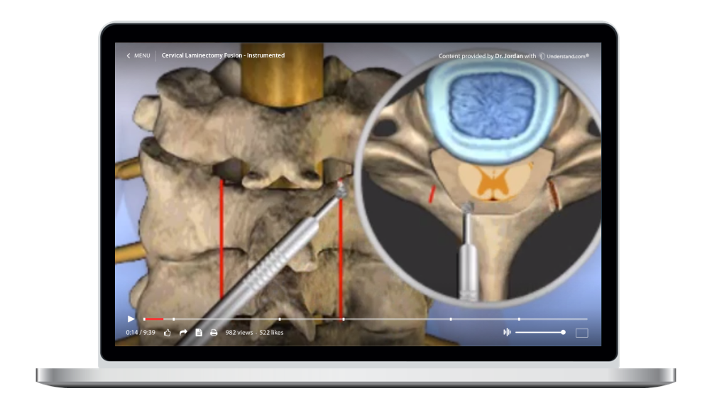 laptop showing a customized Cervical - Cervical Laminectomy, Fusion - Instrumented Animation