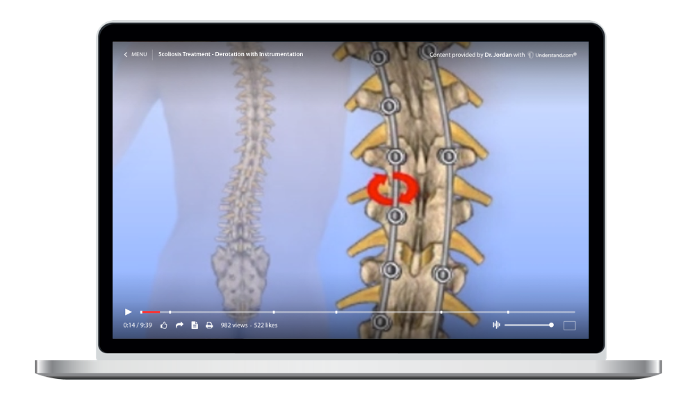 laptop showing a customized Thoracic - Scoliosis Treatment Derotation with Instrumentation Animation