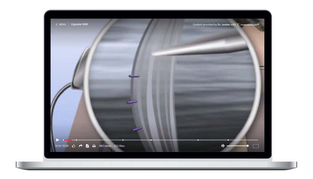 laptop showing a customized Capsular Shift Animation