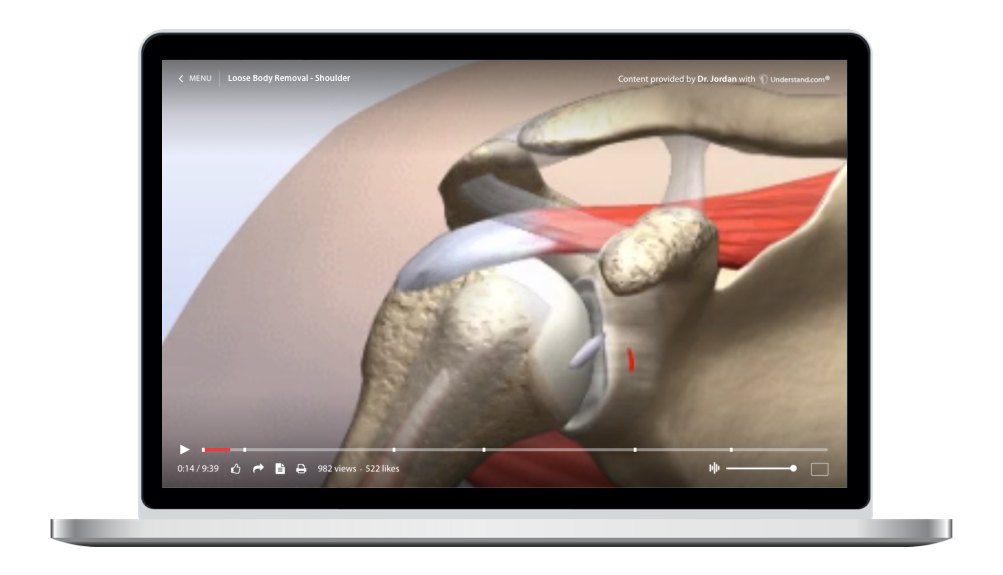 Loose Body Removal Shoulder Animation