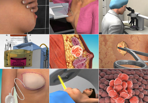 Breast Cancer Library Released by Understand.com® to Educate Patients and their Families