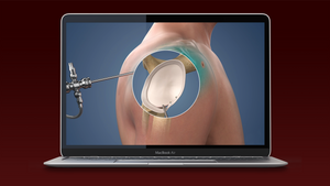 Bankart Repair is the latest HD update to the Orthopaedic Library