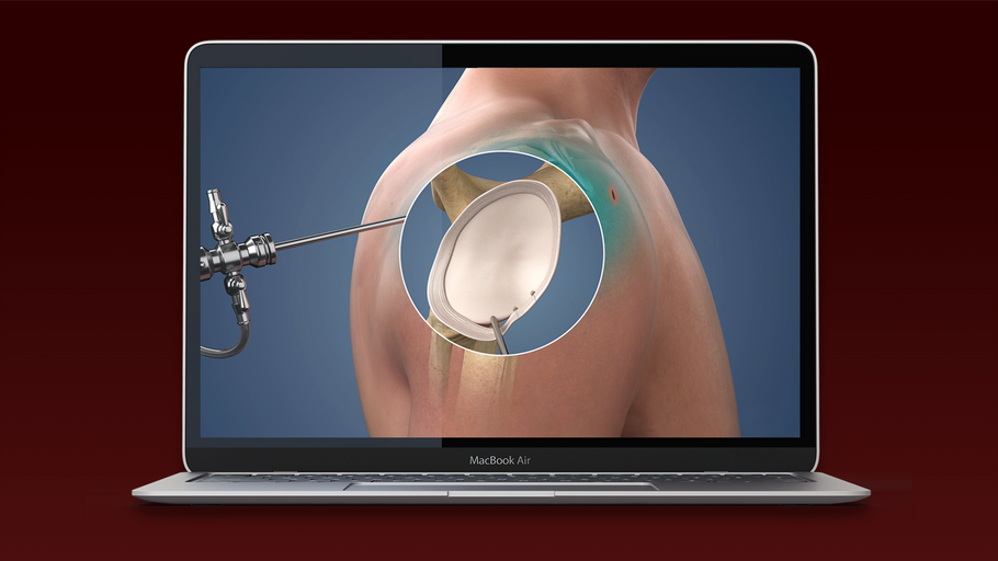 Understand.com<sup>®</sup> continues Orthopaedic Library enhancement with the release of our updated Torn ACL Reconstruction - Hamstring Graft animation