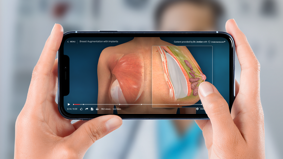 New and improved Breast Augmentation with Implants animation now available in the Plastic Surgery Library