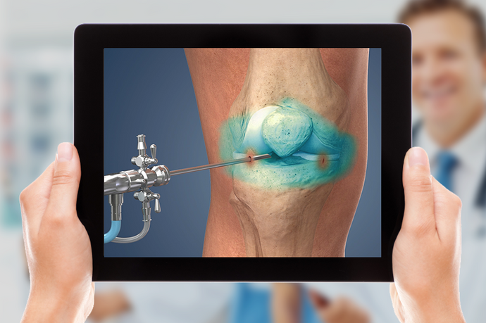 Diagnostic Knee Arthroscopy is the latest HD animation update to Understand.com's® Orthopaedic Library