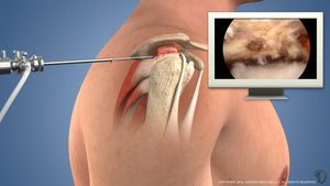 Updated Fully Torn Rotator Cuff Repair Animation