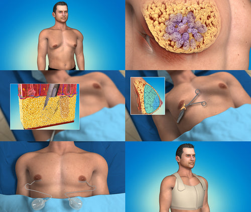 gynecomastia animation which is part of the plastic surgery library
