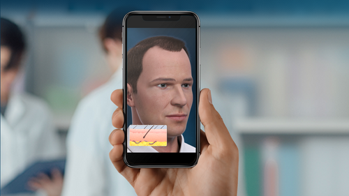 Updated Hair Transplantation animation is the latest addition to our Plastic Surgery and Hair Libraries