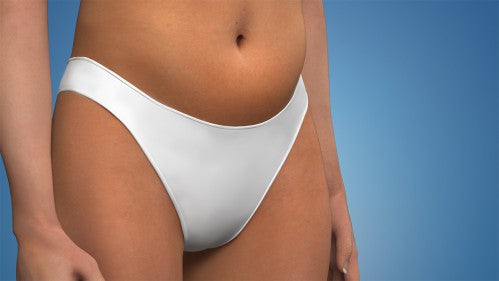 Labiaplasty Animation