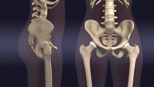 Periacetabular Osteotomy (PAO) Animation