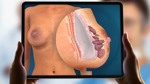 Breast Implant Removal animation added to Plastic Surgery Library
