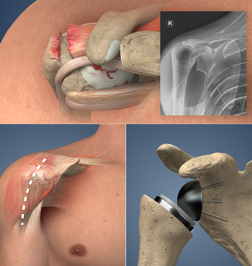 new HD Reverse Total Shoulder Replacement animation