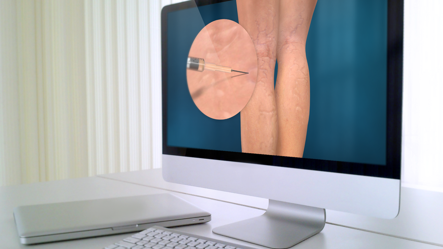 Updated Sclerotherapy animation is the latest improvement to our Plastic Surgery and Dermatology Libraries