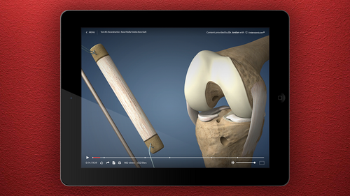 iPad showing new ACL Reconstruction, Bone-Tendon-Bone Graft animation